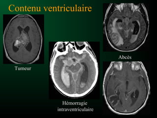 Contenu ventriculaire
Hémorragie
intraventriculaire
Abcès
Tumeur
 