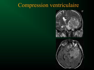 Compression ventriculaire
 