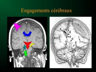 Engagements cérébraux
 