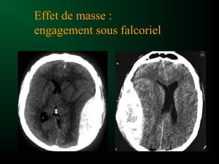 Effet de masse :
engagement sous falcoriel
 