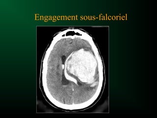 Engagement sous-falcoriel
 