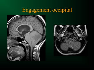 Engagement occipital
 