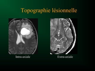 Topographie lésionnelle
Intra-axiale Extra-axiale
 