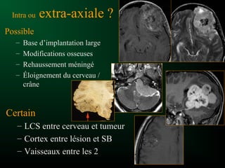 Intra ou extra-axiale ?
Possible
– Base d’implantation large
– Modifications osseuses
– Rehaussement méningé
– Éloignement du cerveau /
crâne
Certain
– LCS entre cerveau et tumeur
– Cortex entre lésion et SB
– Vaisseaux entre les 2
 