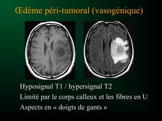 Œdème péri-tumoral (vasogénique)
Hyposignal T1 / hypersignal T2
Limité par le corps calleux et les fibres en U
Aspects en « doigts de gants »
 