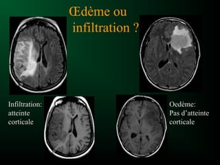Œdème ou
infiltration ?
Infiltration:
atteinte
corticale
Oedème:
Pas d’atteinte
corticale
 