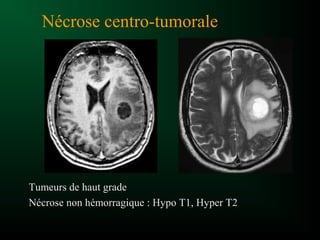 Nécrose centro-tumorale
Tumeurs de haut grade
Nécrose non hémorragique : Hypo T1, Hyper T2
 