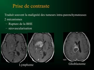 Prise de contraste
Traduit souvent la malignité des tumeurs intra-parenchymateuses
2 mécanismes
– Rupture de la BHE
– néovascularisation
Lymphome Glioblastome
 