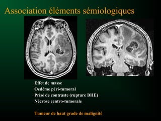 Association éléments sémiologiques
Effet de masse
Oedéme péri-tumoral
Prise de contraste (rupture BHE)
Nécrose centro-tumorale
Tumeur de haut grade de malignité
 