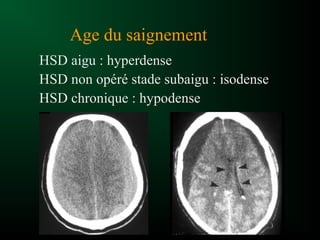 Age du saignement
HSD aigu : hyperdense
HSD non opéré stade subaigu : isodense
HSD chronique : hypodense
 