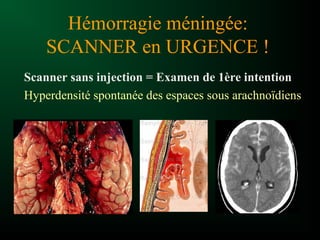 Hémorragie méningée:
SCANNER en URGENCE !
Scanner sans injection = Examen de 1ère intention
Hyperdensité spontanée des espaces sous arachnoïdiens
 