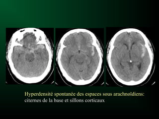 Hyperdensité spontanée des espaces sous arachnoïdiens:
citernes de la base et sillons corticaux
 