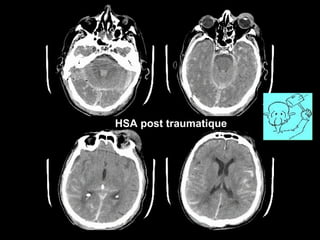 HM
HSA post traumatique
 