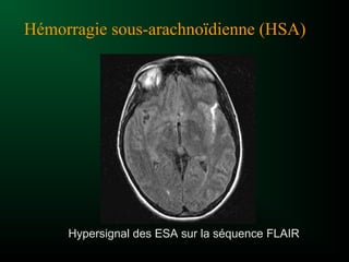 Hypersignal des ESA sur la séquence FLAIR
Hémorragie sous-arachnoïdienne (HSA)
 