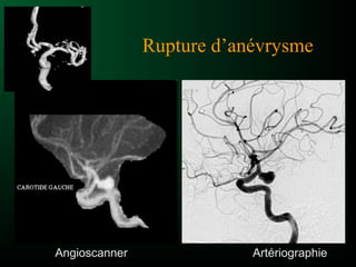 Rupture d’anévrysme
ArtériographieAngioscanner
 
