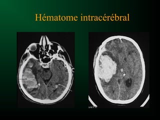 Hématome intracérébral
 