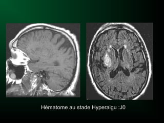 Hématome au stade Hyperaigu :J0
 