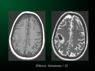 Hématome à 1ZO(rro) : hématome < 2J
 
