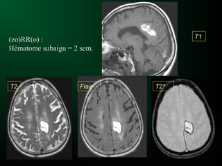 (zo)RR(o) :
Hématome subaigu = 2 sem.
T1
T2 Flair T2*
 