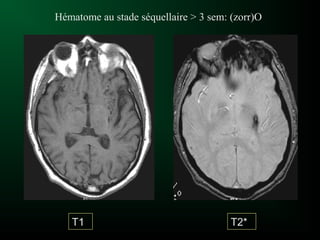 Hématome au stade séquellaire > 3 sem: (zorr)O
T1 T2*
 