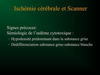 Ischémie cérébrale et Scanner
Signes précoces:
Sémiologie de l’œdème cytotoxique :
– Hypodensité prédominant dans la substance grise
– Dédifférenciation substance grise-substance blanche
 