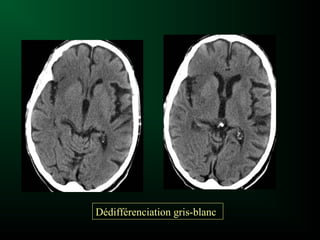 Dédifférenciation gris-blanc
 