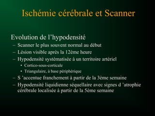 Evolution de l’hypodensité
– Scanner le plus souvent normal au début
– Lésion visible après la 12ème heure
– Hypodensité systématisée à un territoire artériel
• Cortico-sous-corticale
• Triangulaire, à base périphérique
– S ’accentue franchement à partir de la 3ème semaine
– Hypodensité liquidienne séquellaire avec signes d ’atrophie
cérébrale localisée à partir de la 5ème semaine
Ischémie cérébrale et Scanner
 