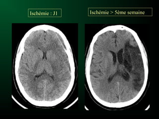 Ischémie : J1 Ischémie > 5ème semaine
 