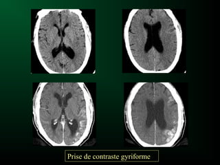 Prise de contraste gyriforme
 