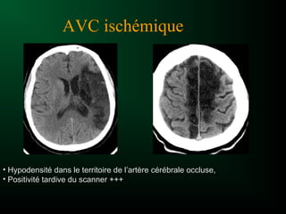 • Hypodensité dans le territoire de l’artère cérébrale occluse,
• Positivité tardive du scanner +++
AVC ischémique
 