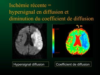 Ischémie récente =
hypersignal en diffusion et
diminution du coefficient de diffusion
Coefficient de diffusionHypersignal diffusion
 