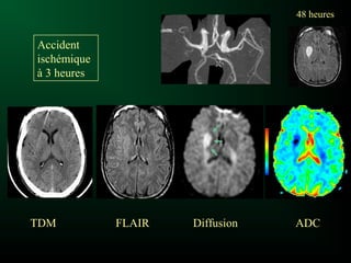48 heures48 heures
TDMTDM FLAIRFLAIR DiffusionDiffusion ADCADC
Accident
ischémique
à 3 heures
 