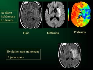 Flair Diffusion Perfusion
AccidentAccident
ischémiqueischémique
à 3 heuresà 3 heures
Evolution sans traitementEvolution sans traitement
2 jours après2 jours après
 