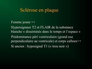 Sclérose en plaque
Femme jeune ++
Hypersignaux T2 et FLAIR de la substance
blanche « disséminés dans le temps et l’espace »
Prédominance péri ventriculaire (grand axe
perpendiculaire au ventricule) et corps calleux++
Si ancien : hyposignal T1 (« trou noir »)
 