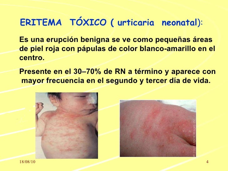 Los granos sobre la persona de por el calor sofocante