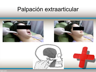 Palpación extraarticular
 