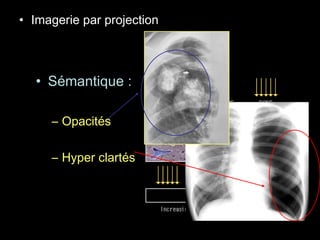 • Imagerie par projection
• Sémantique :
– Opacités
– Hyper clartés
 