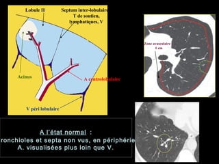 A centrolobulaire
V péri lobulaire
Acinus
Lobule II Septum inter-lobulaire :
T de soutien,
lymphatiques, V
A l’état normal :
Bronchioles et septa non vus, en périphérie
A. visualisées plus loin que V.
Zone avasculaire :
1 cm
V
 