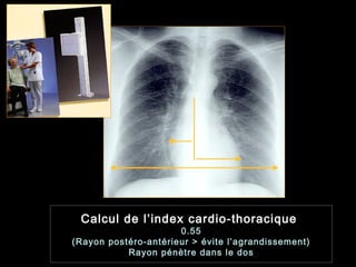 Calcul de l’index cardio-thoracique
0.55
(Rayon postéro-antérieur > évite l’agrandissement)
Rayon pénètre dans le dos
 