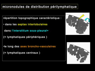 micronodules de distribution périlymphatique
répartition topographique caractéristique :
• dans les septas interlobulaires
dans l’interstitium sous-pleural+
(= lymphatiques périphériques )
•le long des axes broncho-vasculaires
(= lymphatiques centraux )
 