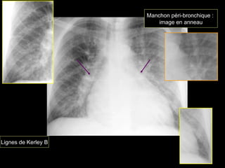 Lignes de Kerley B
Manchon péri-bronchique :
image en anneau
 