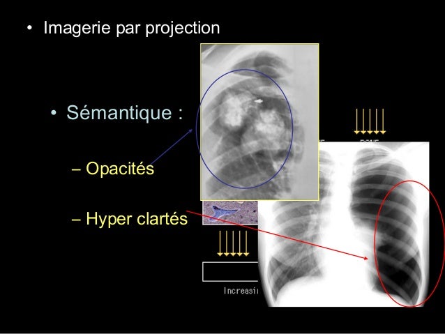 Semio radio thorax