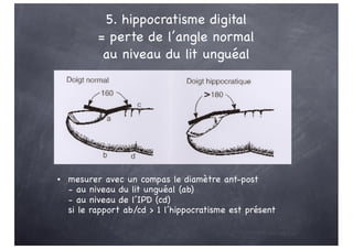 5. hippocratisme digital
= perte de l’angle normal
au niveau du lit unguéal
• mesurer avec un compas le diamètre ant-post
- au niveau du lit unguéal (ab)
- au niveau de l’IPD (cd)
si le rapport ab/cd > 1 l’hippocratisme est présent
 