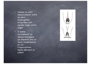 • Examen du petit
espace présent entre
les deux
phalangettes
lorsqu'elles sont
placées ongle contre
ongle:
• Il existe
normalement un
espace losangique
qui disparaît plus ou
moins complètement
en cas
l'hippocratisme
digital débutant ou
patent.
 