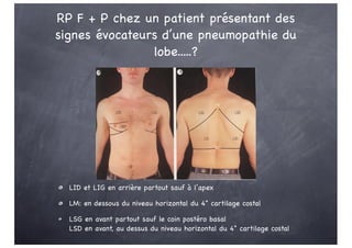 RP F + P chez un patient présentant des
signes évocateurs d’une pneumopathie du
lobe.....?
LID et LIG en arrière partout sauf à l’apex
LM: en dessous du niveau horizontal du 4° cartilage costal
LSG en avant partout sauf le coin postéro basal
LSD en avant, au dessus du niveau horizontal du 4° cartilage costal
T2
T10
 