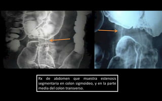 Colon En Rx Semiología Radiologica | PPTX