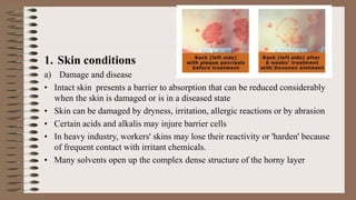 1. Skin conditions
a) Damage and disease
• Intact skin presents a barrier to absorption that can be reduced considerably
when the skin is damaged or is in a diseased state
• Skin can be damaged by dryness, irritation, allergic reactions or by abrasion
• Certain acids and alkalis may injure barrier cells
• In heavy industry, workers' skins may lose their reactivity or 'harden' because
of frequent contact with irritant chemicals.
• Many solvents open up the complex dense structure of the horny layer
 