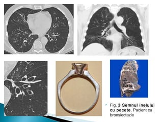  Fig. 3 Semnul inelului
cu pecete. Pacient cu
bronsiectazie
 