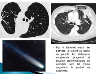  Fig. 4 Semnul cozii de
cometa; a.Pacient cu istoric
de pleurita tbc; atelectazie
subpleurala (sageata) si
structuri bronhovasculare cu
extindere spre hil (restul
sagaetilor); b. pacient cu
azbestoza,
 