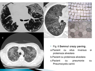  Fig. 6 Semnul crazy paving.
a.Pacient cu situs inversus si
proteinoza alveolara
b.Pacient cu proteinoza alveolara
c.Pacient cu pneumonie cu
Pneumocystis carinii
a
b
cc
 